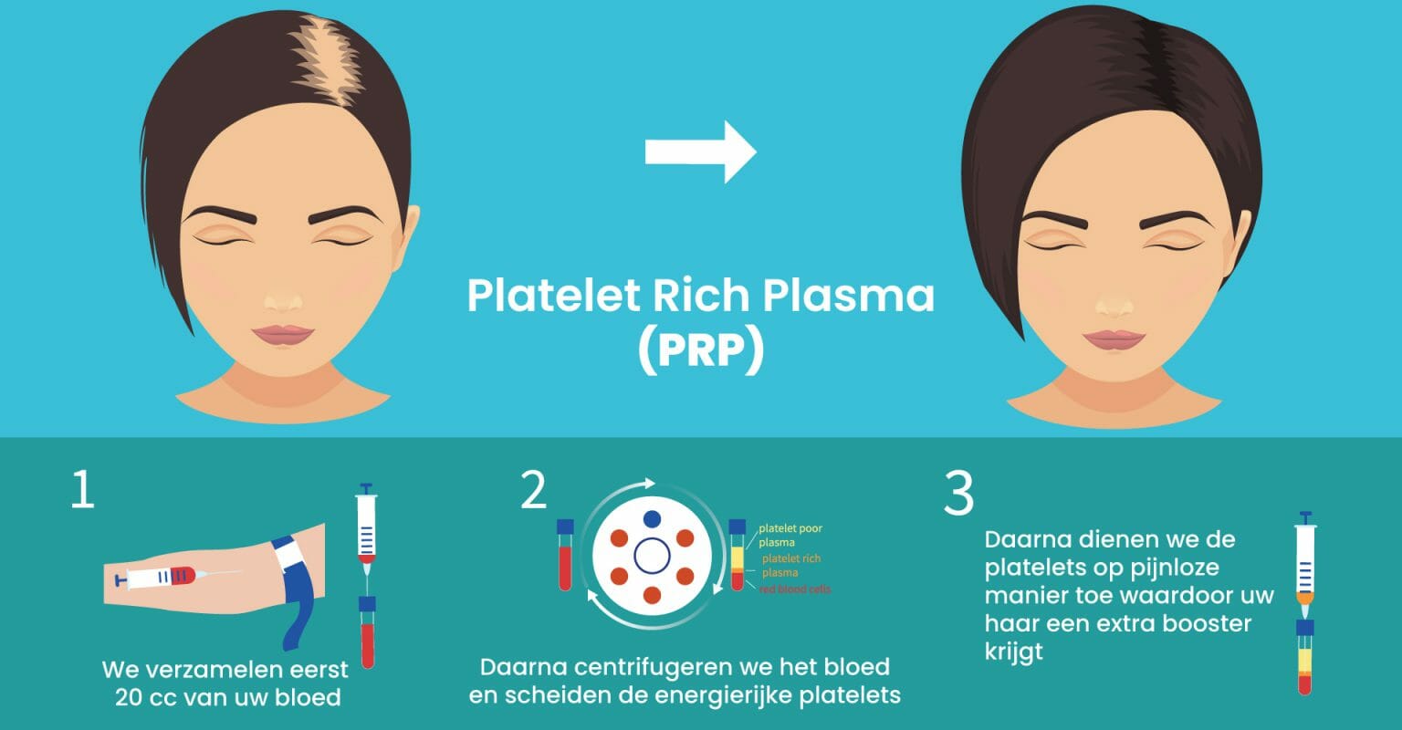 PRP behandeling Hairtec Haarkliniek PRP